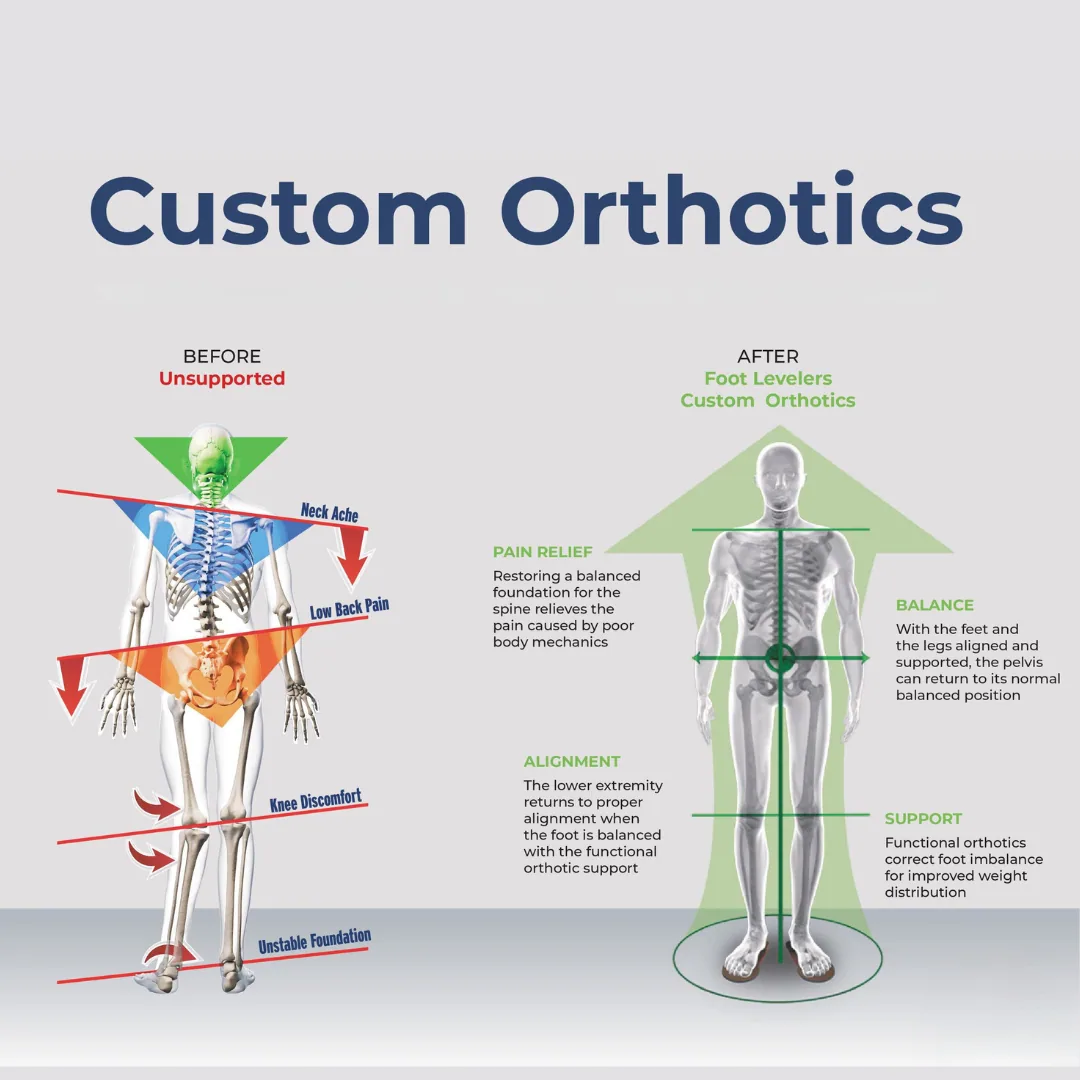 A Foot Levelers diagram comparing an unsupported stance with one corrected by custom orthotics